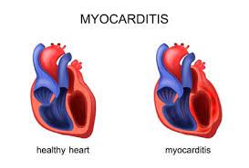How is myocarditis diagnosed?